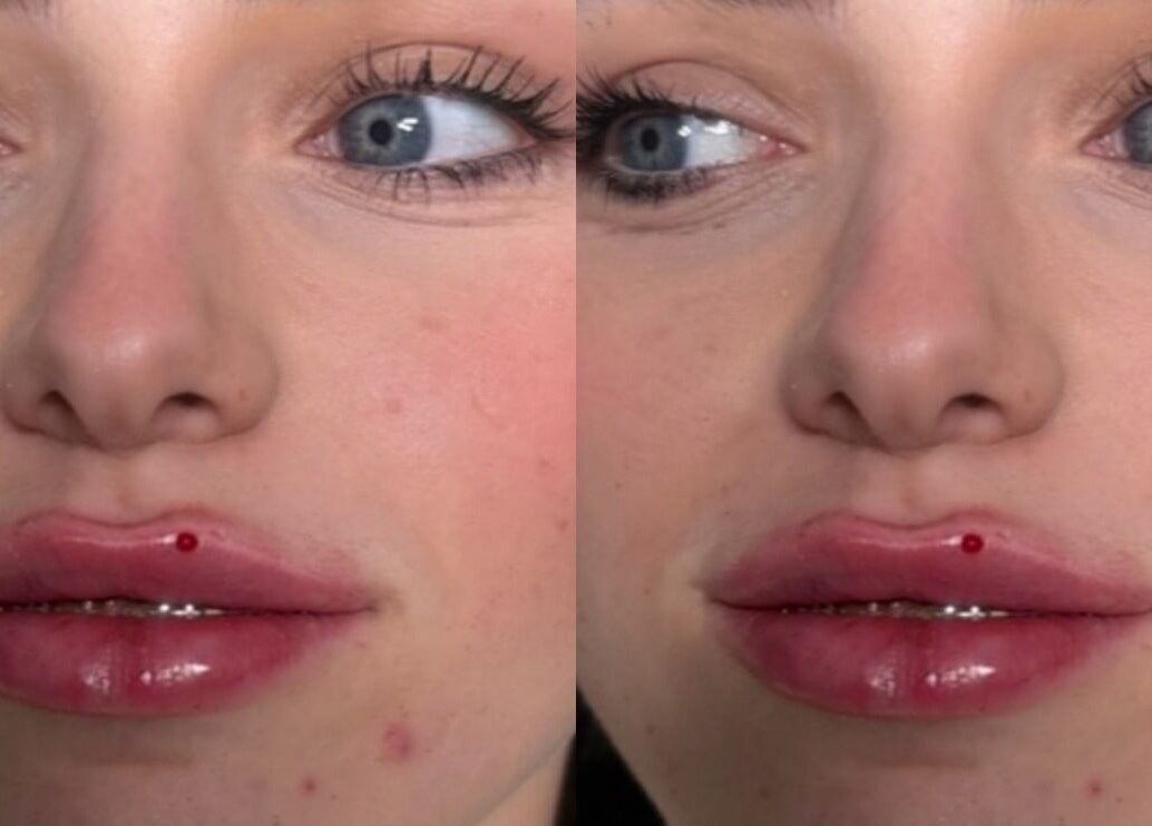 Close-up of lip enhancement results at Aestheticsbysophia, Liverpool, England, GB.