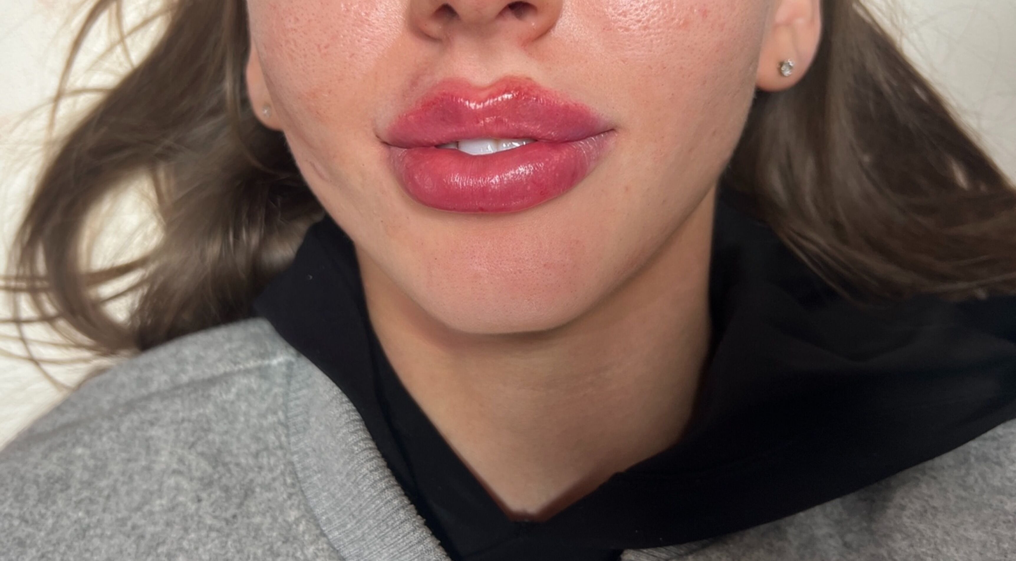 Close-up of enhanced lips at Aestheticsbysophia, Liverpool, England, GB.