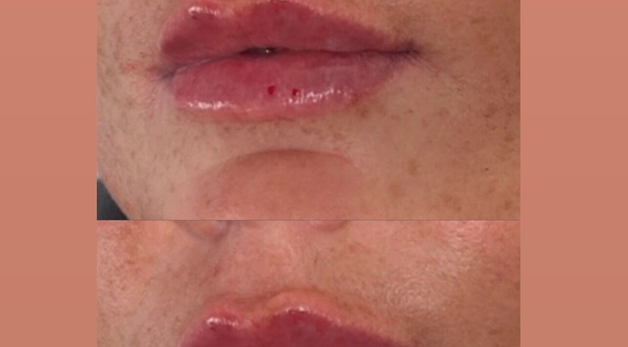 Before and after lip enhancement at Aestheticsbysophia, Liverpool, England, GB.