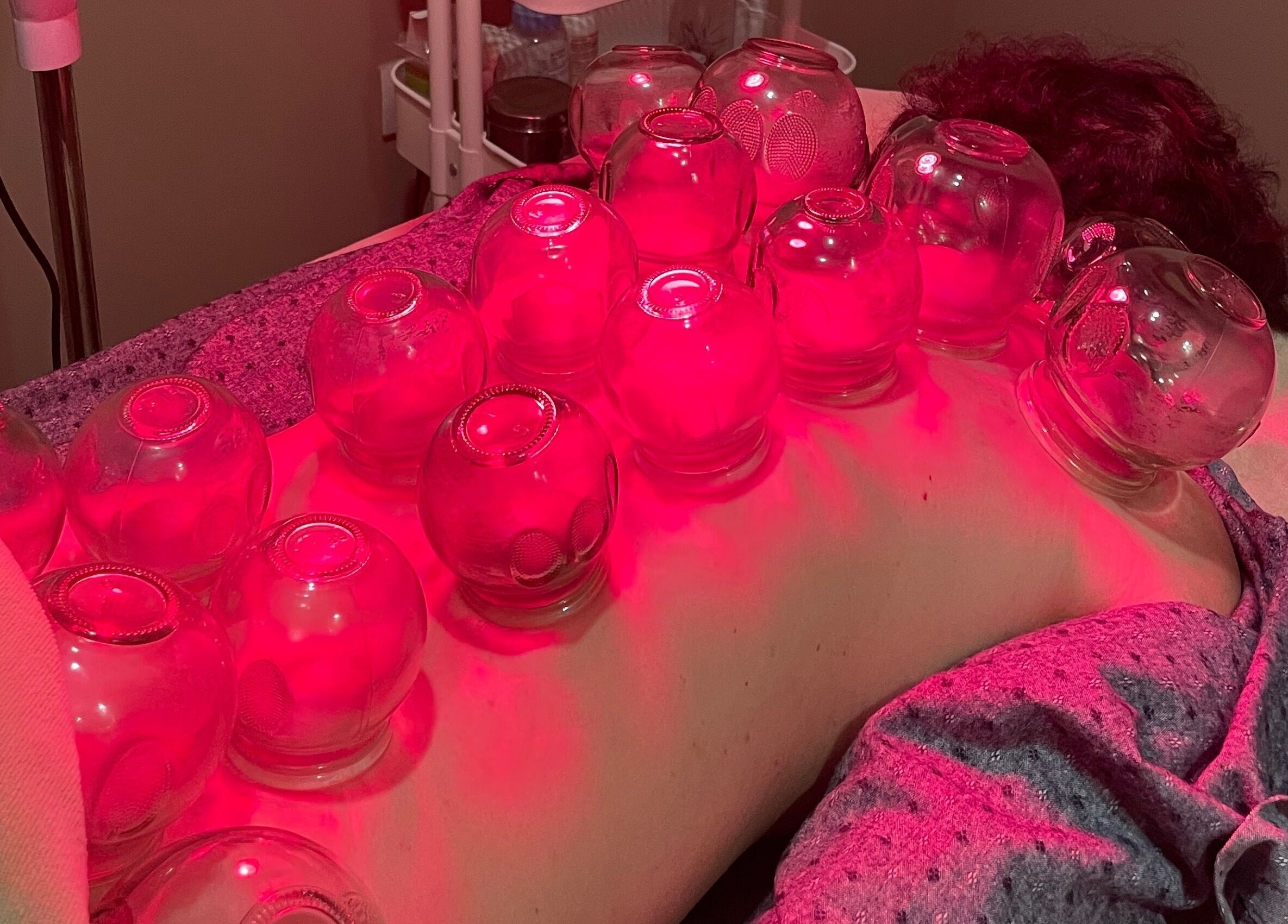 Cupping therapy session at Ai Ling TCM & Acupuncture, Petaling Jaya, Selangor, MY with red lighting.