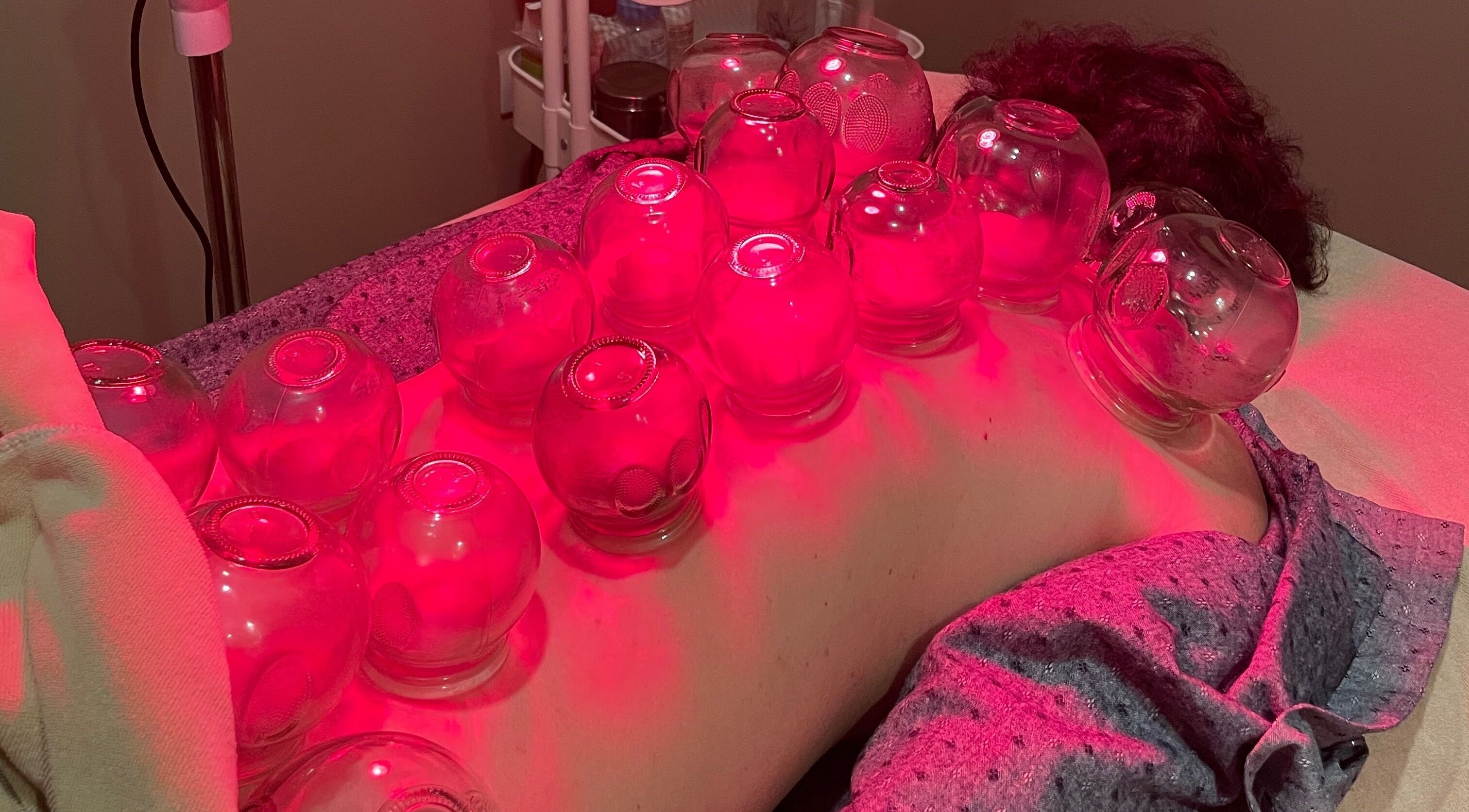 Cupping therapy session at Ai Ling TCM & Acupuncture, Petaling Jaya, Selangor, MY with red lighting.