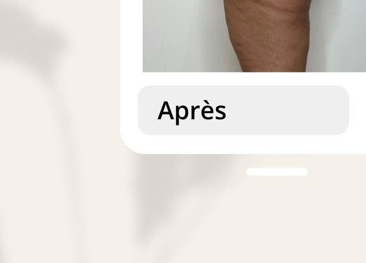 Résultat d'un traitement à domicile chez Esthelisa Esthéticienne au Kremlin-Bicêtre, Île-de-France, FR.