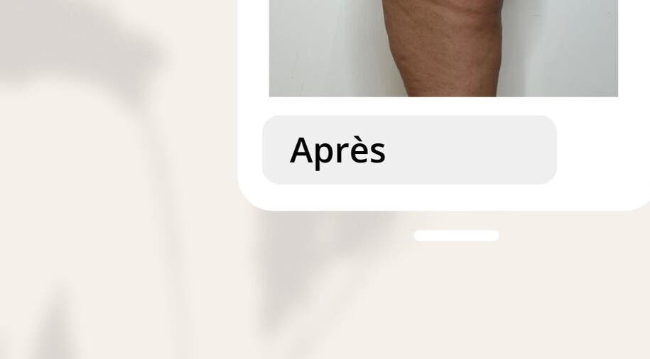 Résultat d'un traitement à domicile chez Esthelisa Esthéticienne au Kremlin-Bicêtre, Île-de-France, FR.