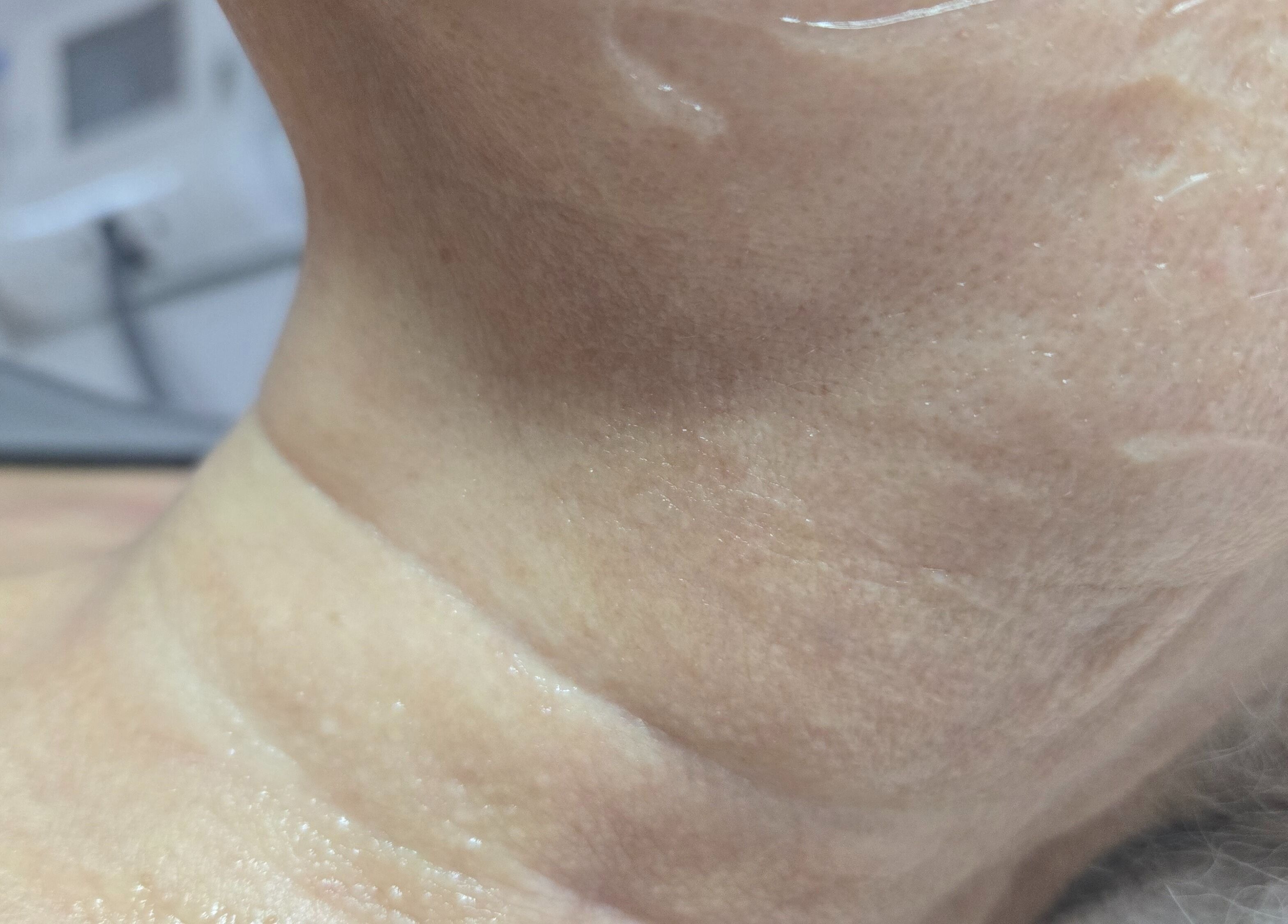 Tratamiento de rejuvenecimiento en Depila2, Willemstad, CW, mostrando piel del cuello.