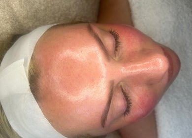 Facial treatment at ForEva Skin in Wishaw, Scotland, GB, showcasing radiant skin post-treatment.