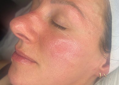 Close-up of a facial treatment at ForEva Skin, Wishaw, Scotland, GB, showcasing glowing skin.