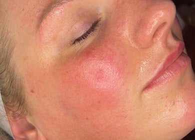 Close-up of glowing skin after treatment at ForEva Skin, Wishaw, Scotland, GB.