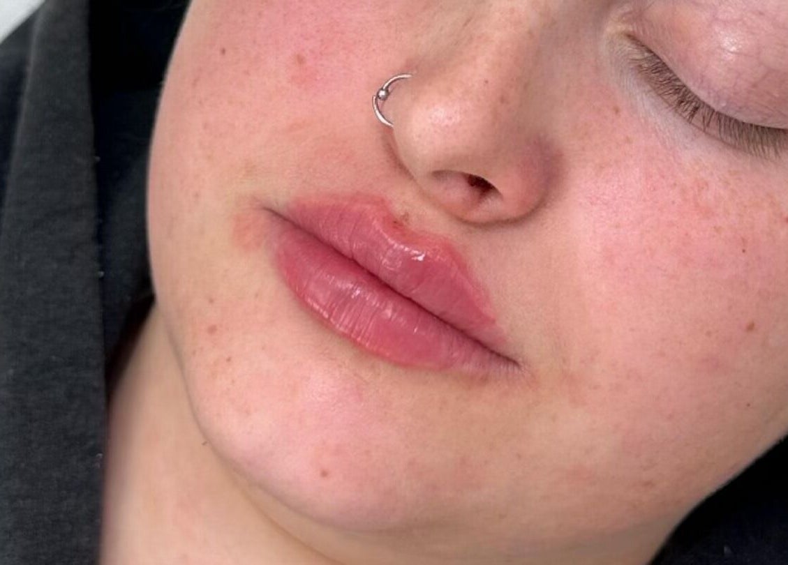 Smooth lip enhancement at OMORFIA Medi Aesthetics Tiverton, Bolham, England, GB.