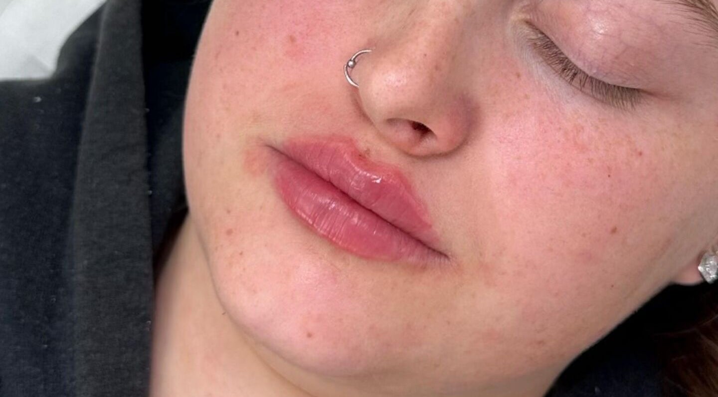 Smooth lip enhancement at OMORFIA Medi Aesthetics Tiverton, Bolham, England, GB.