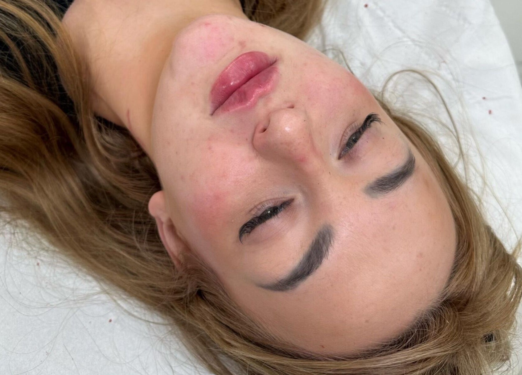 Client receiving rejuvenating treatment at OMORFIA Medi Aesthetics Tiverton, Bolham, England, GB.