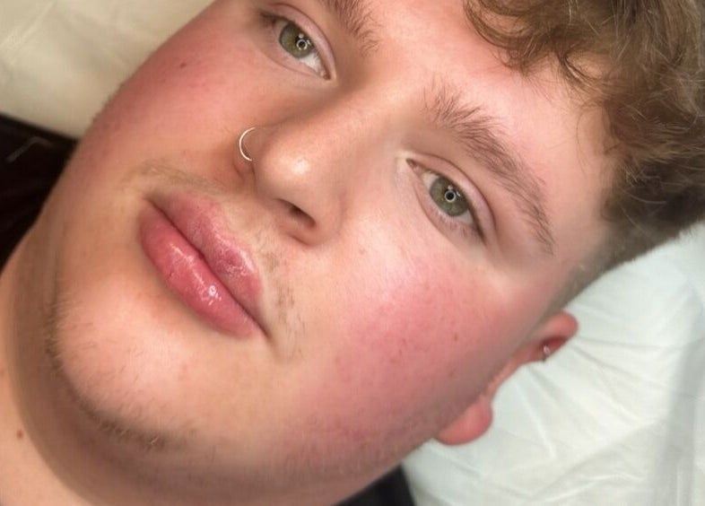 Client with rejuvenated skin at OMORFIA Medi Aesthetics Tiverton, Bolham, England, GB.