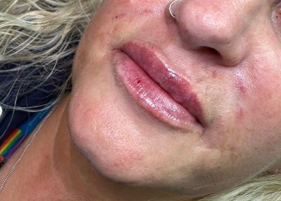 Close-up of lips after treatment at OMORFIA Medi Aesthetics Tiverton, Bolham, England, GB.
