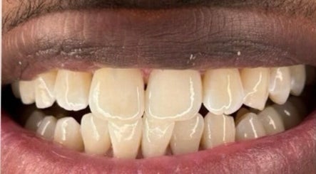 Instant White Teeth Whitening image 2