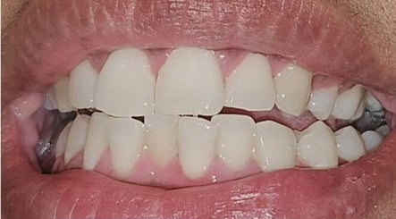 Instant White Teeth Whitening image 3