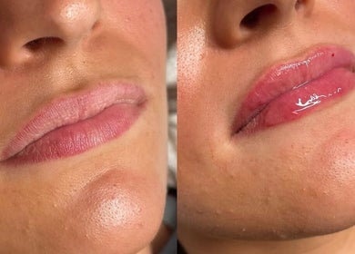 Before and after lip enhancement at Aesthetics By Anna, Southport, England, GB, showcasing fuller lips.