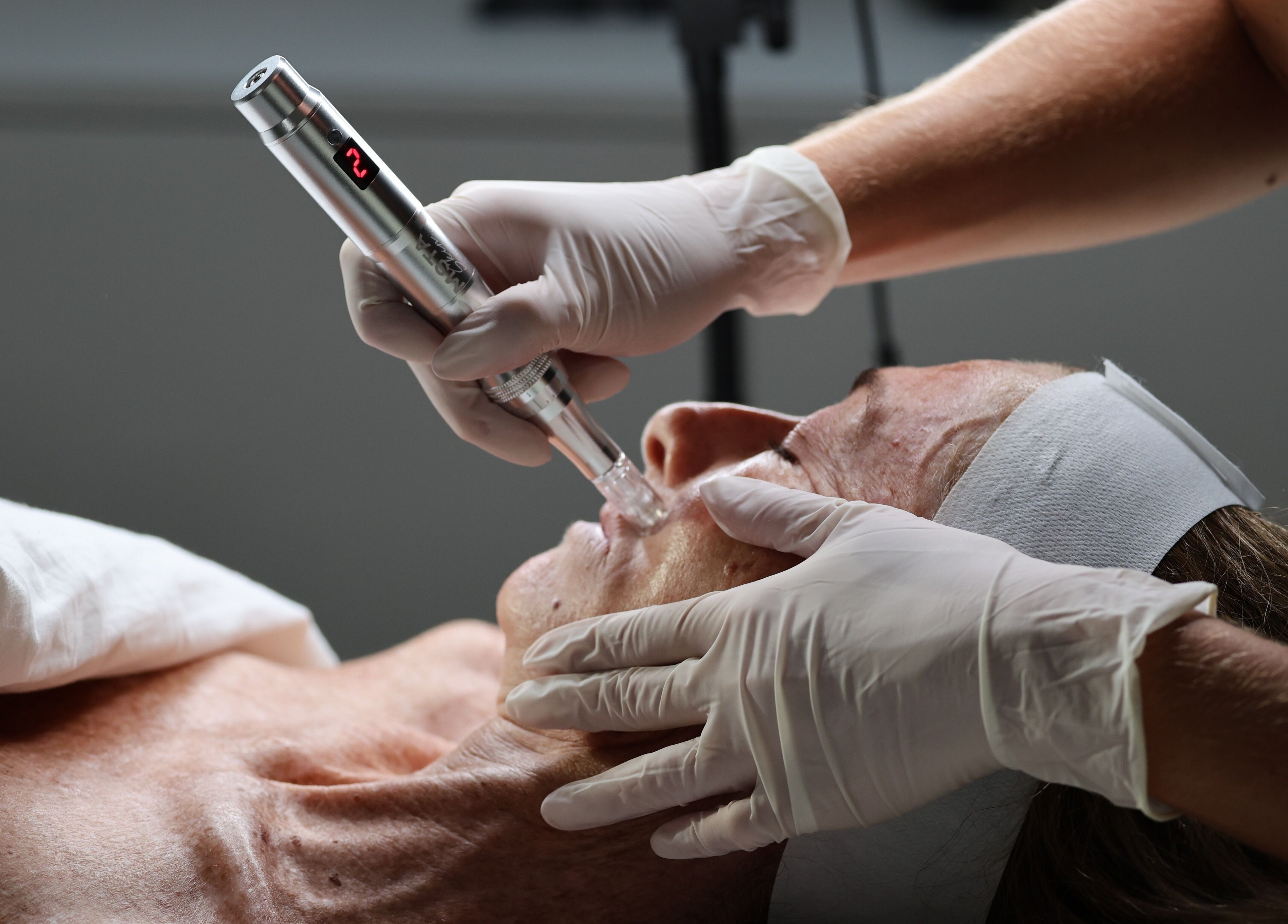 Microneedling treatment at Skin Diary By Toyah, London, England, GB, enhancing facial rejuvenation.