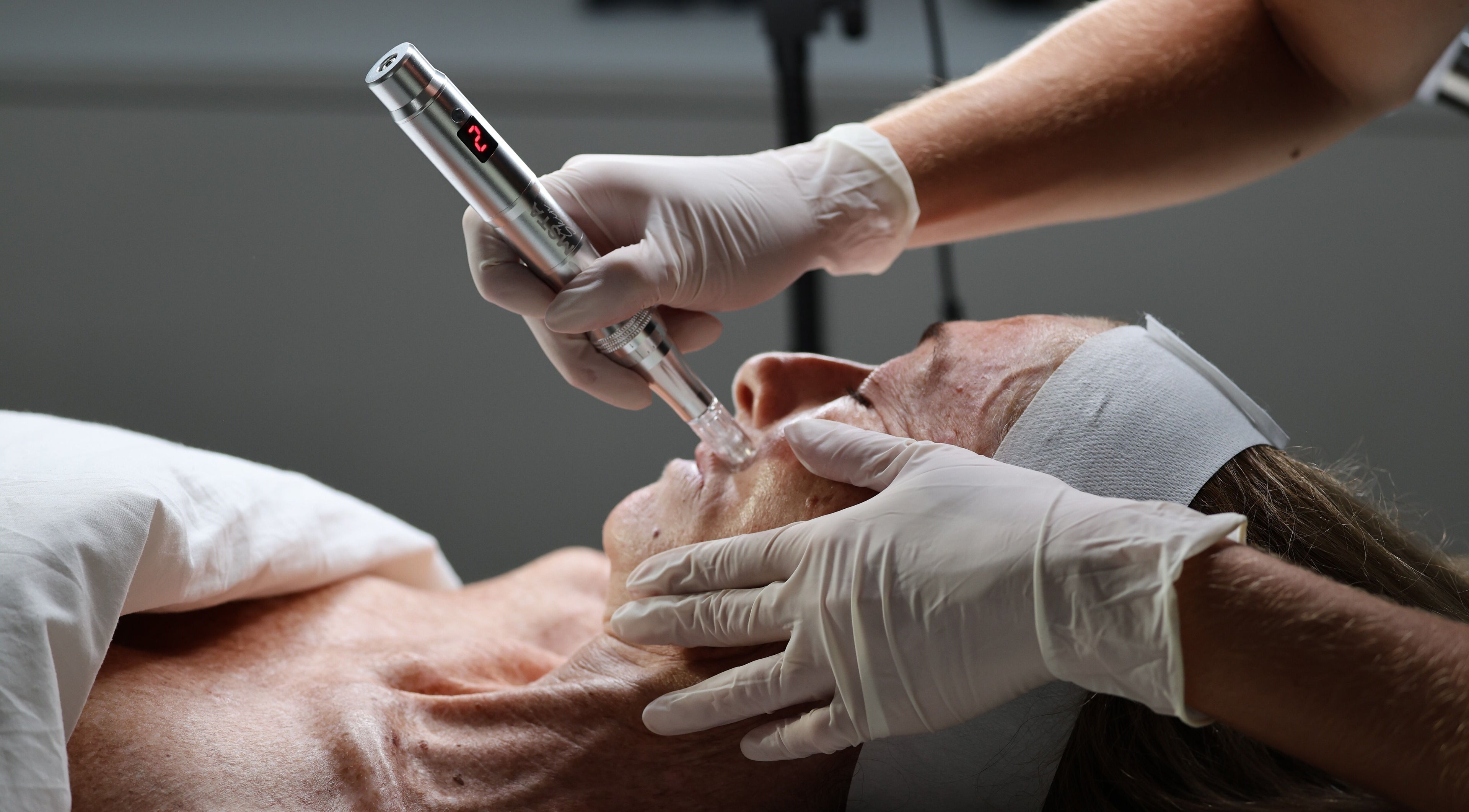 Microneedling treatment at Skin Diary By Toyah, London, England, GB, enhancing facial rejuvenation.