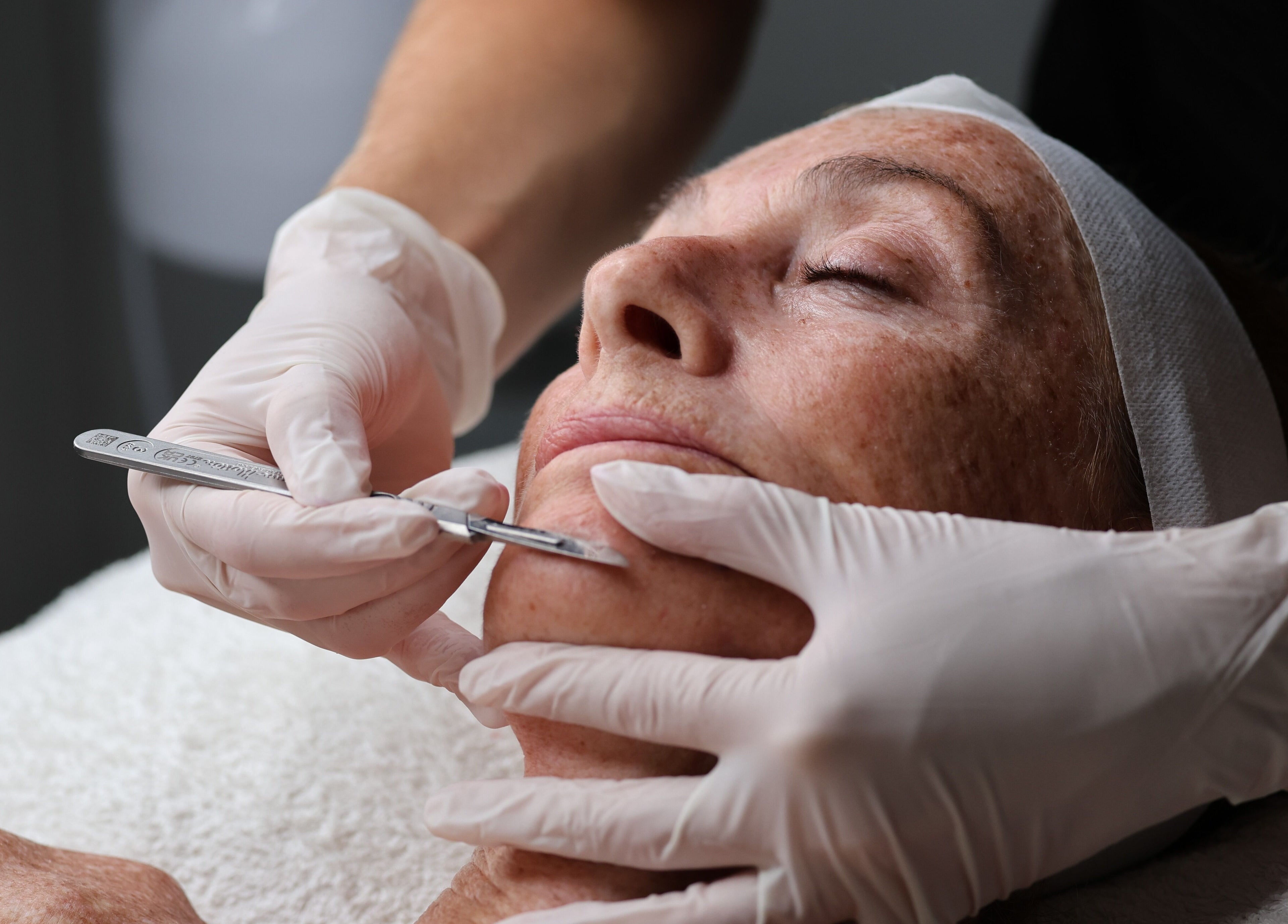 Professional dermaplaning treatment at Skin Diary By Toyah in London, England, GB for smooth, radiant skin.