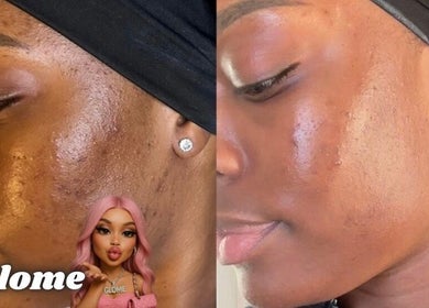 Before and after skin treatment at GLOME, London, England, GB. Visible improvement in complexion.