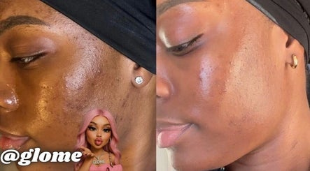 Before and after skin treatment at GLOME, London, England, GB. Visible improvement in complexion.