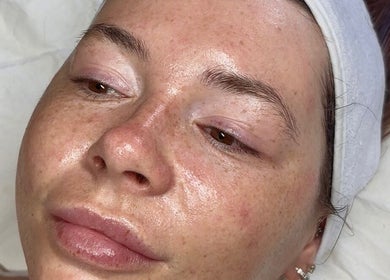 Close-up of fresh, radiant skin post-treatment at Your Skin Club, Wakefield, England, GB.