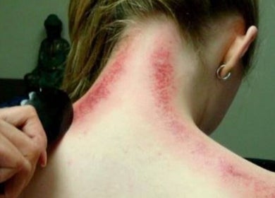 Gua Sha treatment at Body Tunes Remedial Massage, Lancefield, Victoria, AU, relieving muscle tension.