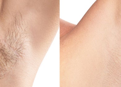 Before and after laser hair removal at Femme Laser Clinic Concord, Vaughan, Ontario, CA.