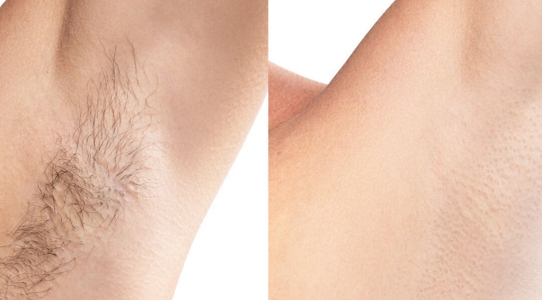 Before and after laser hair removal at Femme Laser Clinic Concord, Vaughan, Ontario, CA.