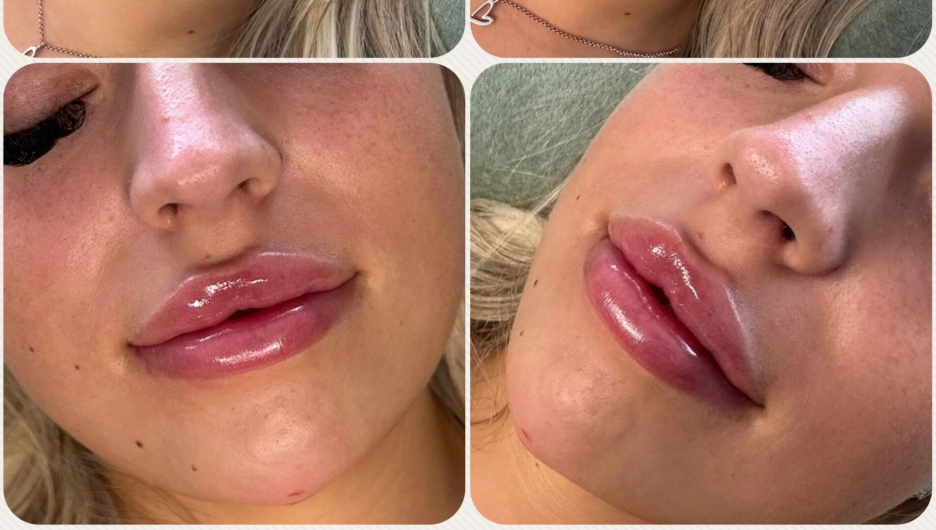 Close-up of enhanced lips at Belle Beauty & Aesthetics, Perth, Scotland, GB. Shiny, smooth lip treatment result.