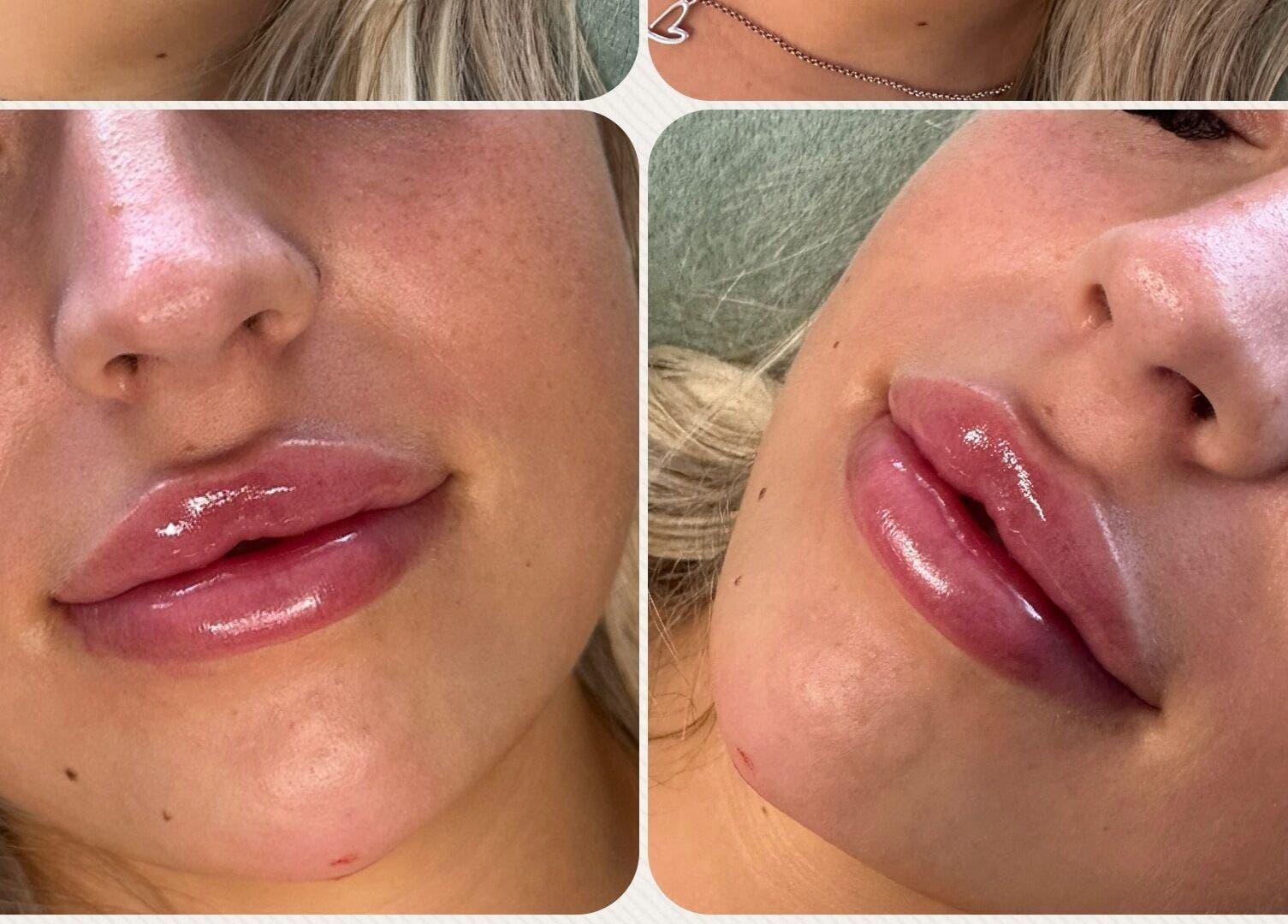 Close-up of enhanced lips at Belle Beauty & Aesthetics, Perth, Scotland, GB. Shiny, smooth lip treatment result.