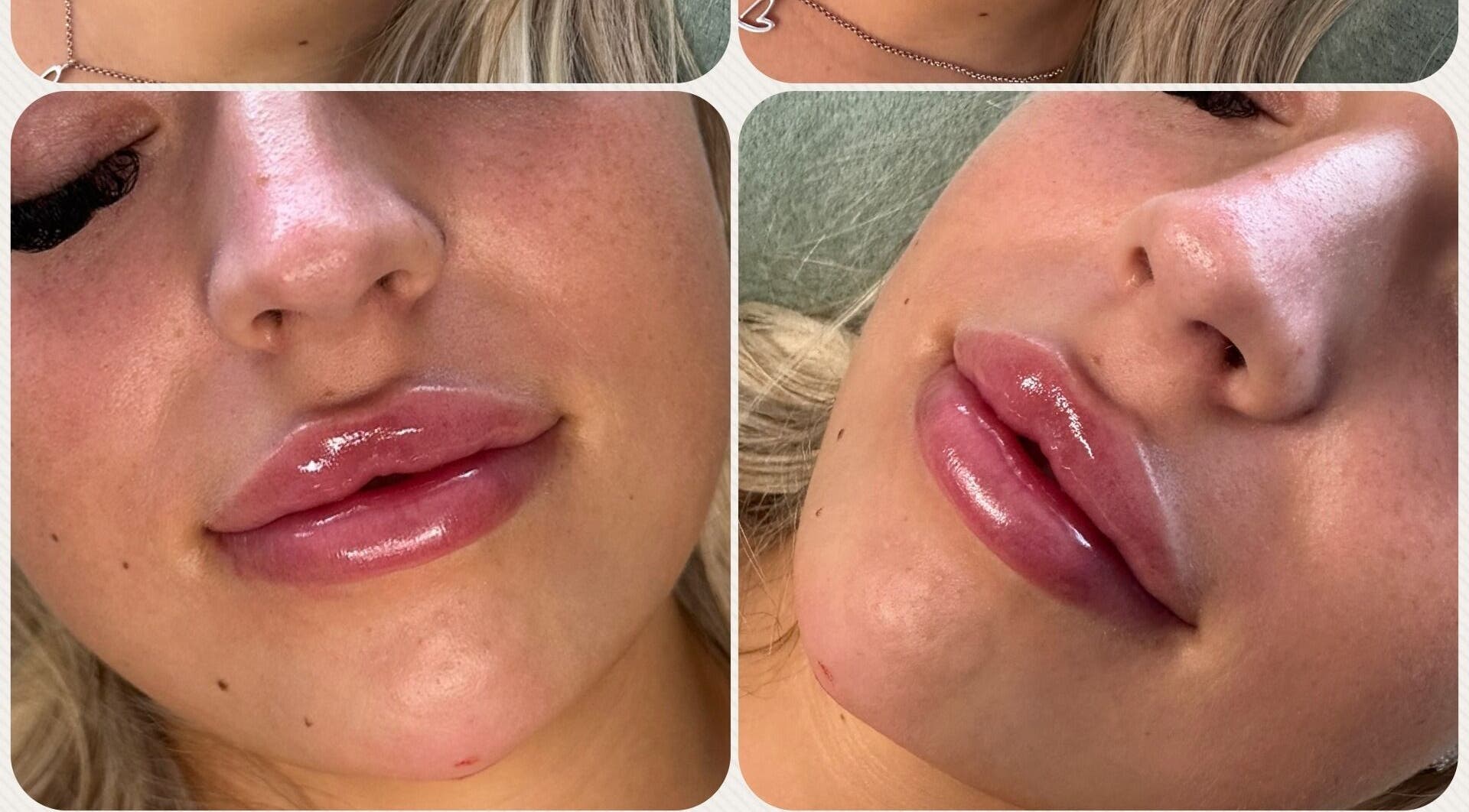 Close-up of enhanced lips at Belle Beauty & Aesthetics, Perth, Scotland, GB. Shiny, smooth lip treatment result.