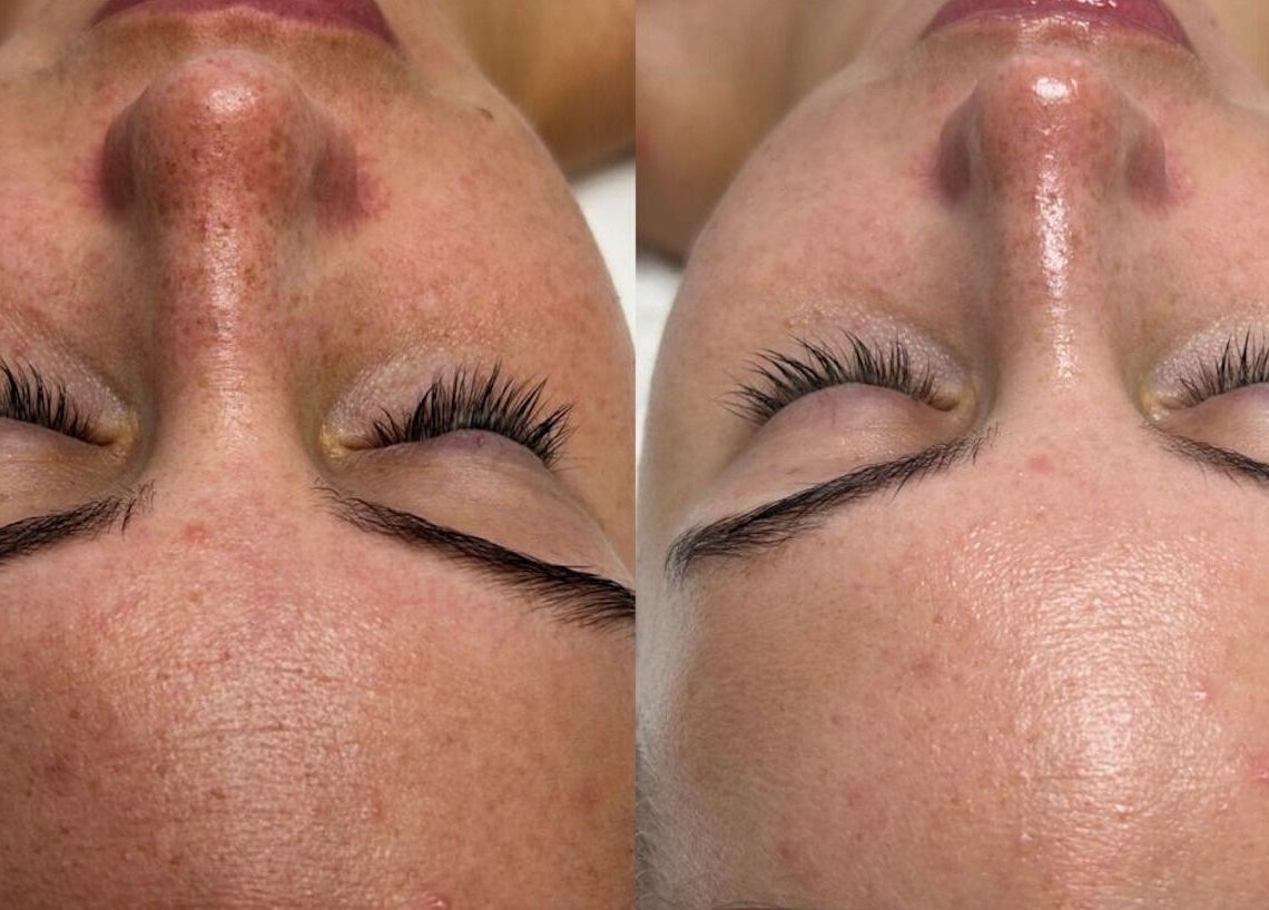 Comparison of skin texture before and after treatment at Defined Cosmetics, Labrador, Queensland, AU.