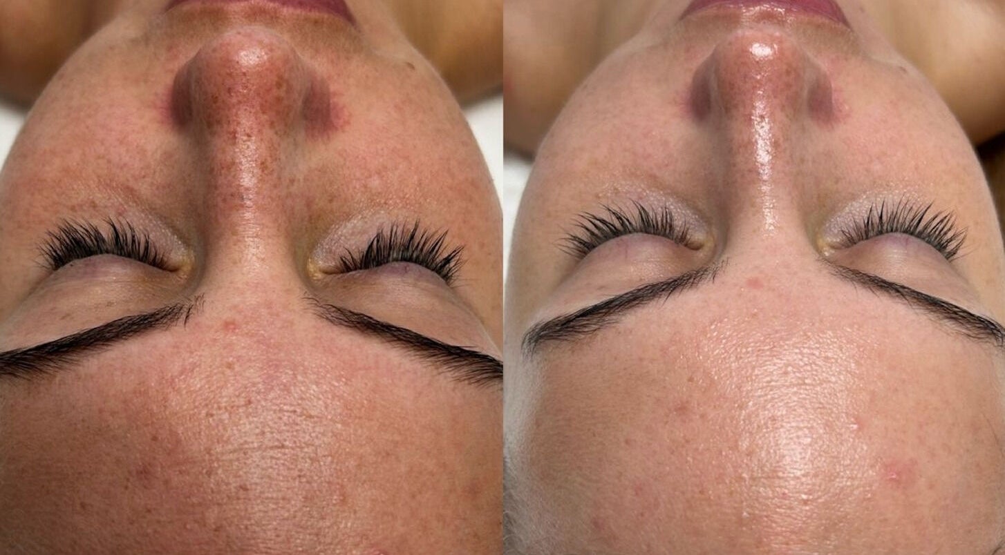 Comparison of skin texture before and after treatment at Defined Cosmetics, Labrador, Queensland, AU.