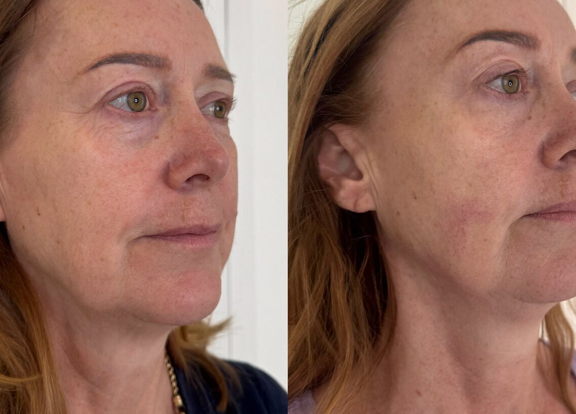 Before and after skincare results at Defined Cosmetics, Labrador, Queensland, AU.