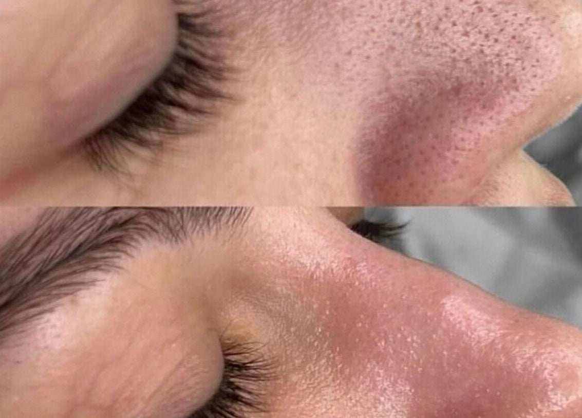 Before and after facial treatment at Defined Cosmetics in Labrador, Queensland, AU, showcasing skin improvement.