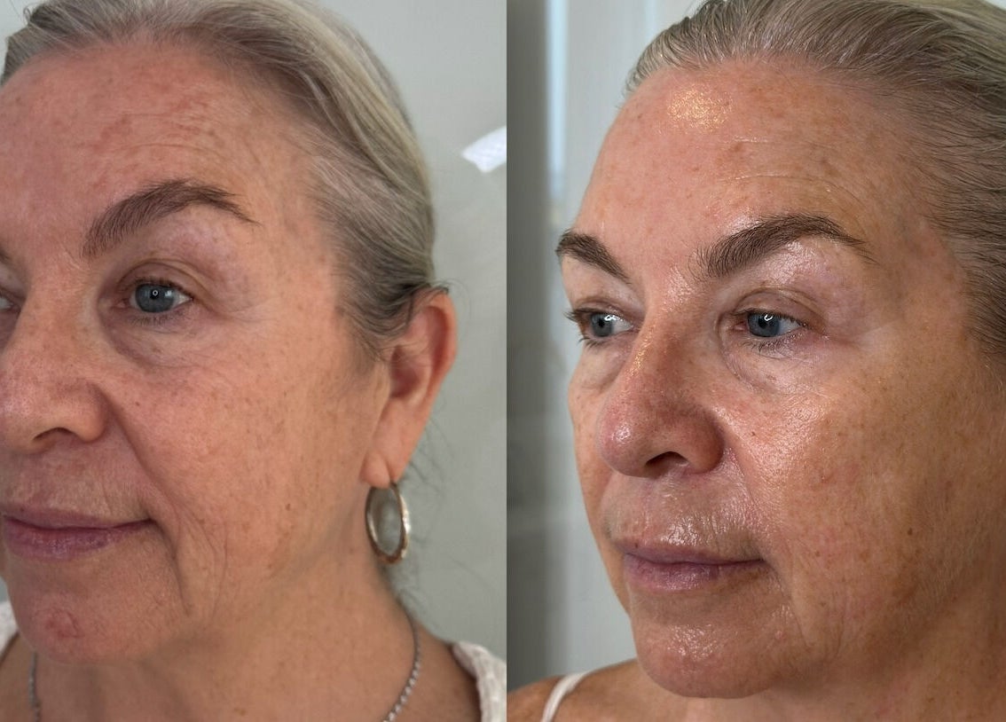 Defined Cosmetics facial rejuvenation before and after in Labrador, Queensland, AU showcasing skin improvement.