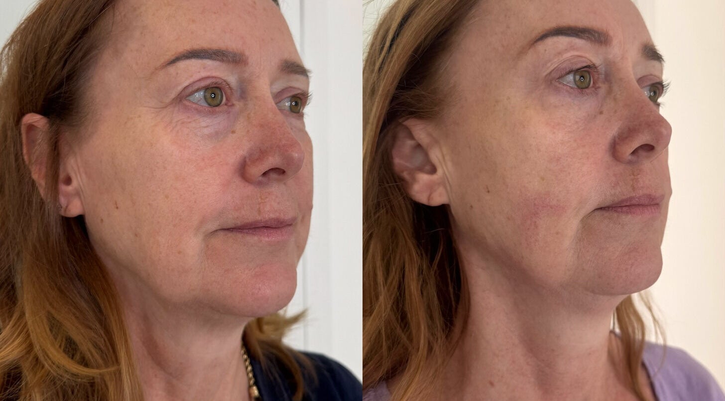 Before and after wrinkle treatment at Defined Cosmetics, Labrador, Queensland, AU, highlighting smooth skin results.