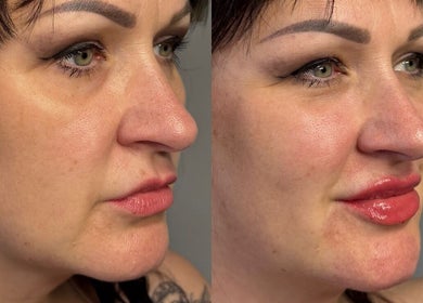 Before and after results of beauty treatment at Rare Aesthetics UK, Brighton And Hove, GB.
