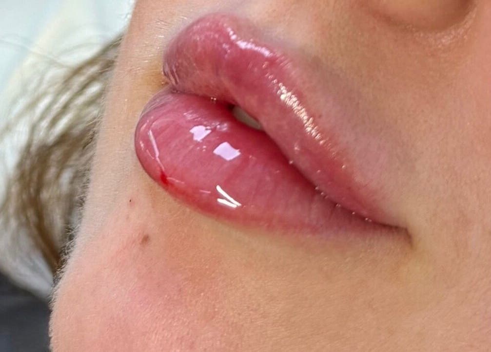 Close-up of glossy lips enhancement at Rare Aesthetics UK, Brighton And Hove, GB.