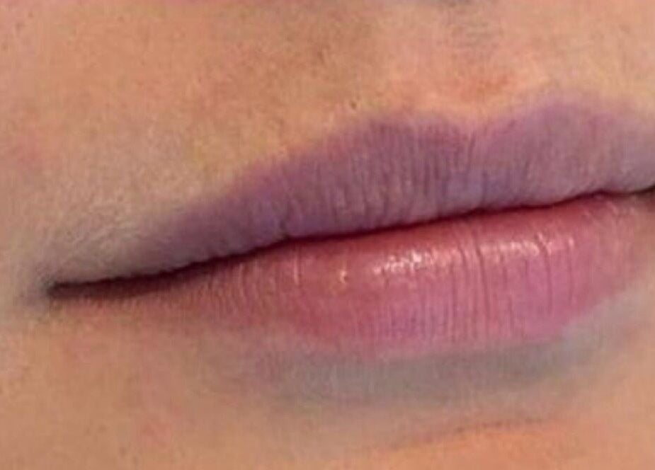 Close-up of enhanced lips at Redefined Aesthetics & Skin, Bargoed, Wales, GB for beauty treatments.