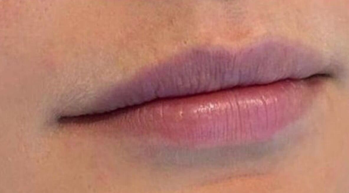 Close-up of enhanced lips at Redefined Aesthetics & Skin, Bargoed, Wales, GB for beauty treatments.