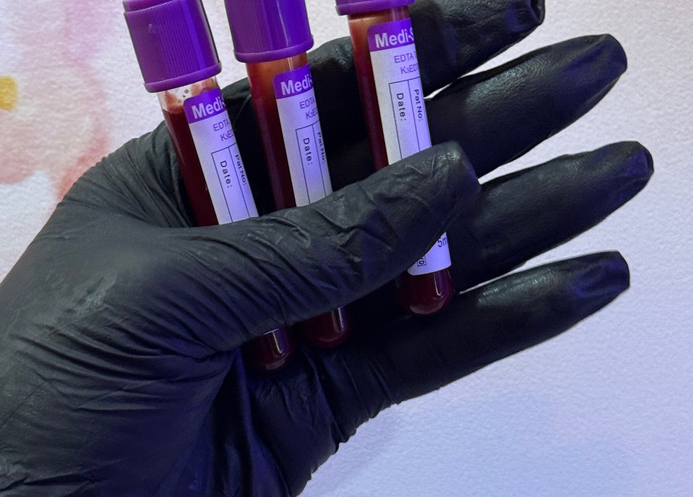 Black-gloved hand holding blood vials at Xtragleam Aesthetic Clinic, Ijebu Ode Ibadan garage, Ogun State, NG.