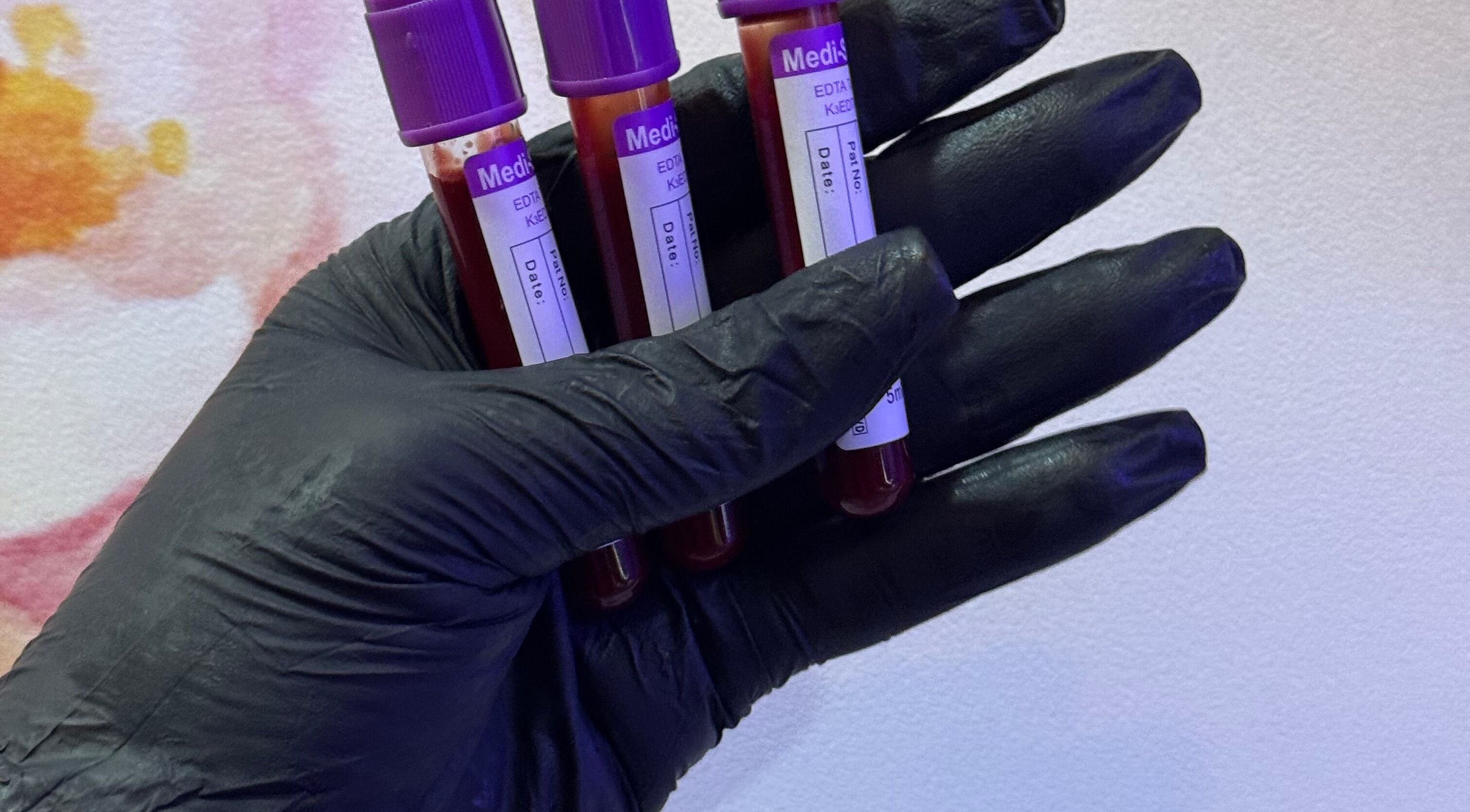 Black-gloved hand holding blood vials at Xtragleam Aesthetic Clinic, Ijebu Ode Ibadan garage, Ogun State, NG.