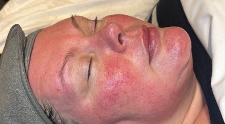 Facial treatment at Refresh Skin Therapy in Southampton, England, GB showcasing rejuvenated skin.