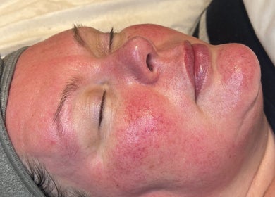 Facial treatment at Refresh Skin Therapy in Southampton, England highlighting smooth, rejuvenated complexion.