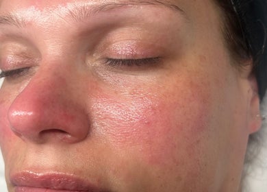 Closeup of a woman's glowing skin after treatment at Refresh Skin Therapy, Southampton, England, GB.