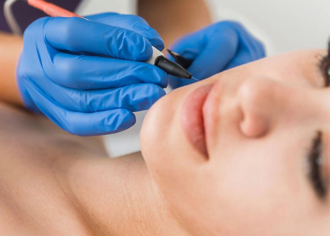 Precision Pulse Electrolysis treatment in progress in Nashville, Tennessee, US.