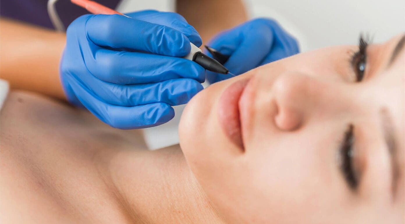Precision Pulse Electrolysis treatment in progress in Nashville, Tennessee, US.