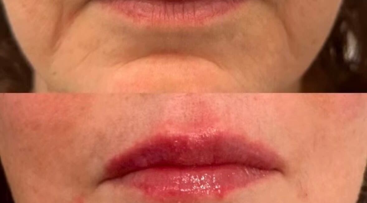 Avant-après traitement des lèvres chez CBMEDCLIN Médico Esthétique Brésilienne, Longueuil, Québec, CA.