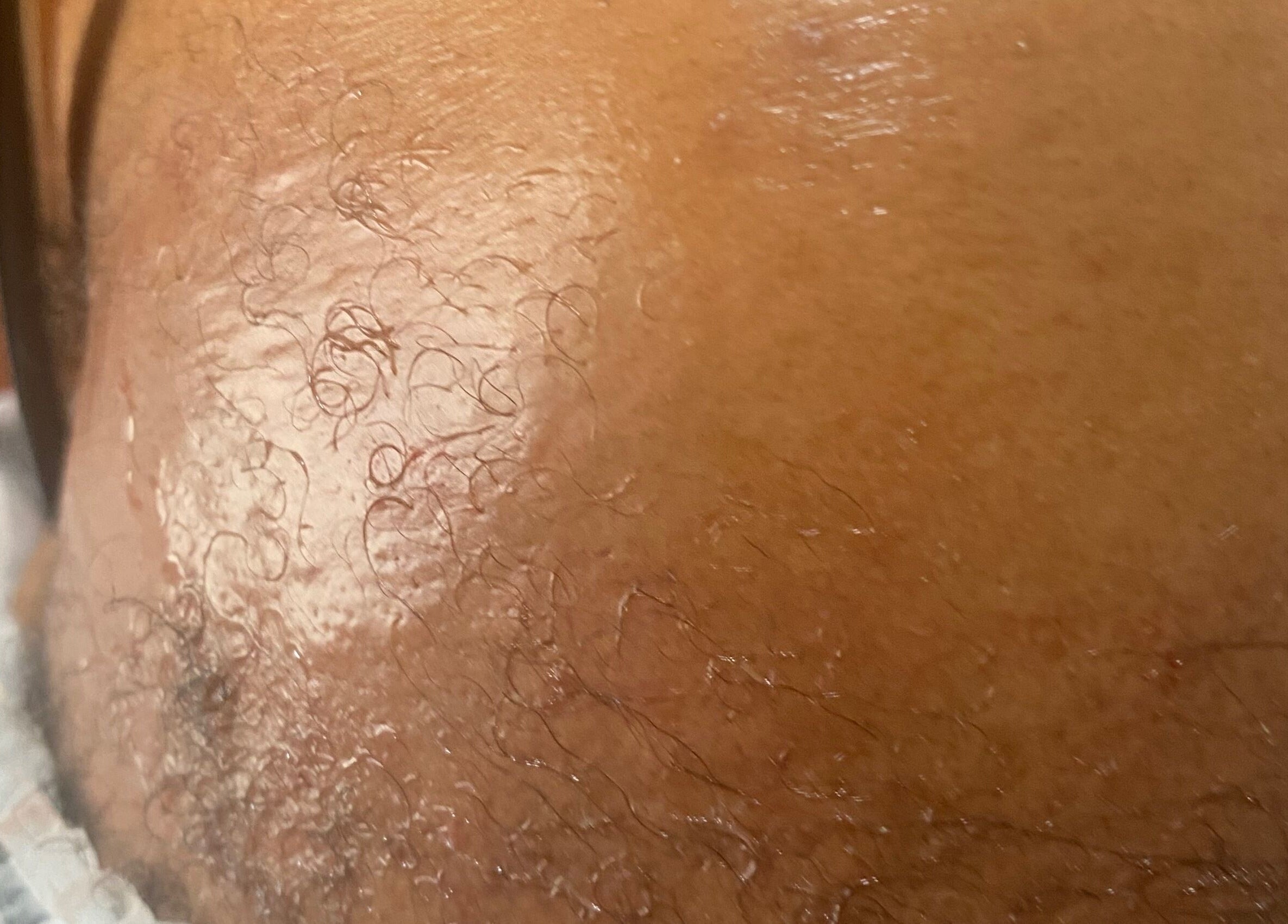 Close-up of a treated area on the face at New You Medical Aesthetics JHB, Sandton, Gauteng, ZA.